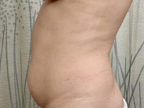 BodyTite 12 Before 2