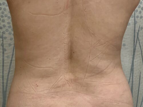 BodyTite 12 Before 3