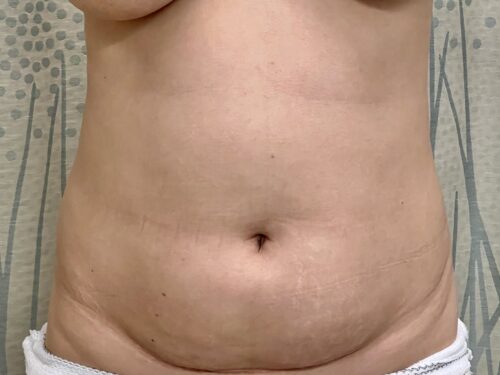 BodyTite 12 Before 1