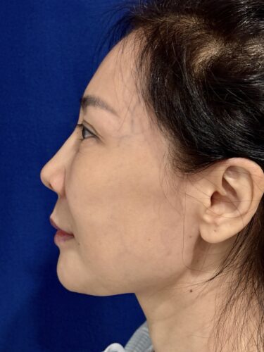 Facelift 16 Quantum RF Before 3