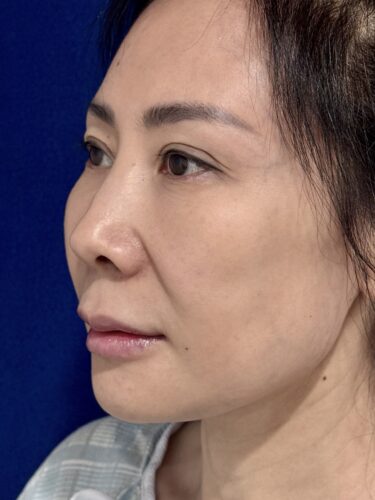 Facelift 16 Quantum RF Before 2