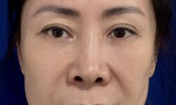 Facelift 16 Quantum RF Before