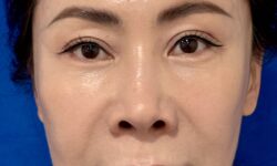 Facelift 16 Quantum RF After