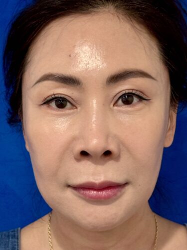 Facelift 16 Quantum RF After 1