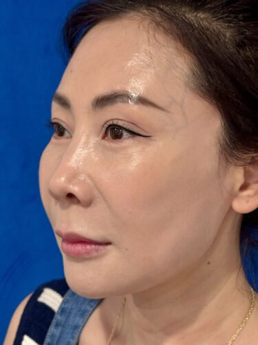 Facelift 16 Quantum RF After 2