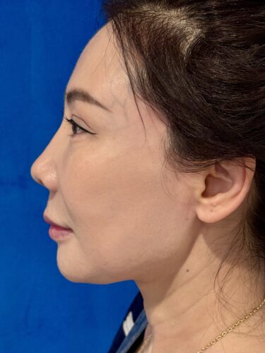 Facelift 16 Quantum RF After 3