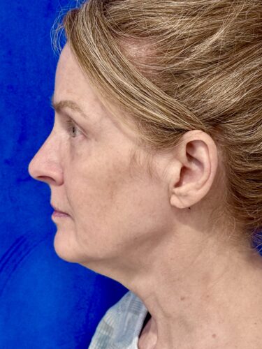 Neck Lift 06 Before 3