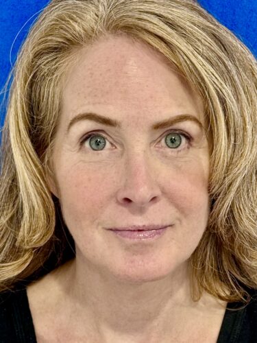 Neck Lift 06 After 1