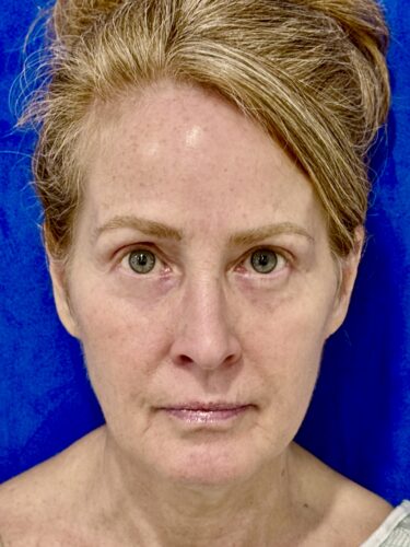 Neck Lift 06 Before 1