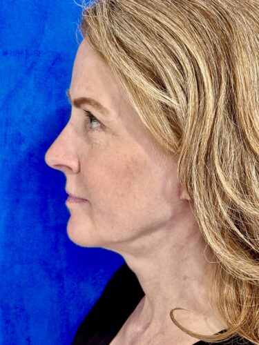 Neck Lift 06 After 3