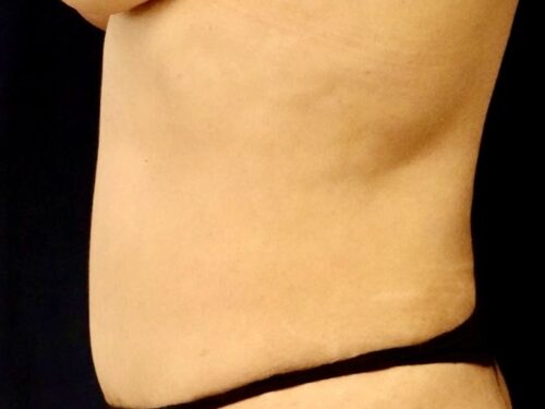 BodyTite 13 Before 2