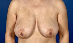 Breast Lift 13 Before