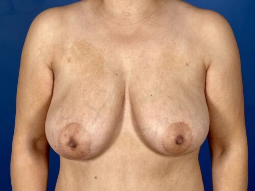 Breast Lift 13 Before 1