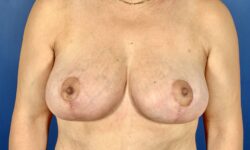 Breast Lift 13 After