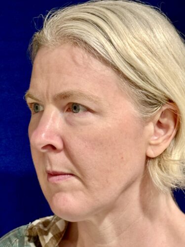 Eyelid Surgery 18 Before 2