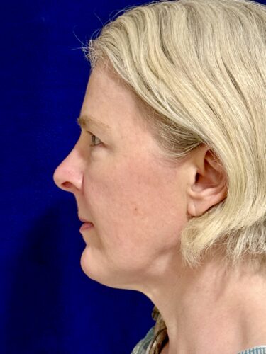 Eyelid Surgery 18 Before 3