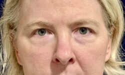 Eyelid Surgery 18 Before