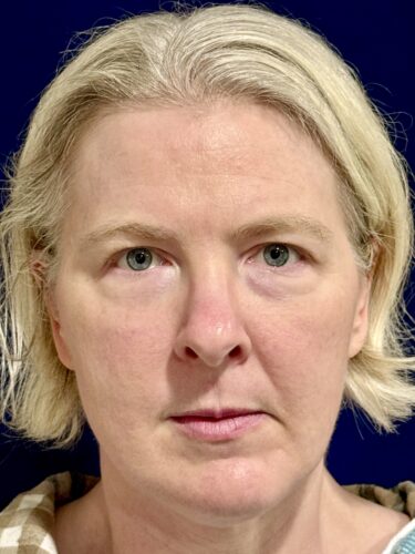 Eyelid Surgery 18 Before 1