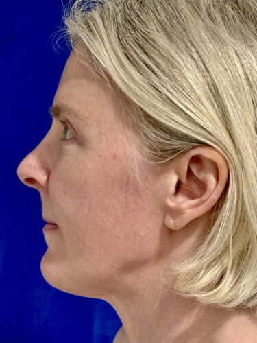 Eyelid Surgery 18 After 3