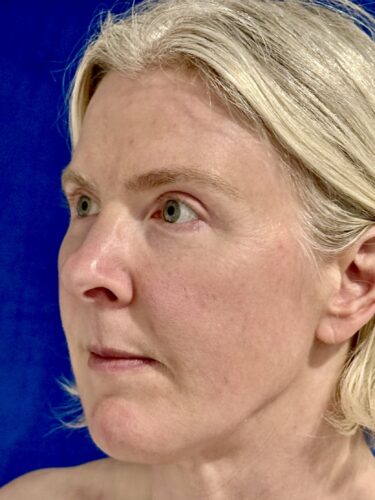 Eyelid Surgery 18 After 2