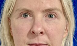 Eyelid Surgery 18 After