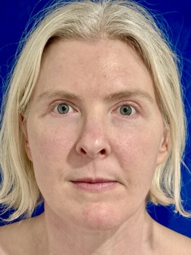 Eyelid Surgery 18 After 1