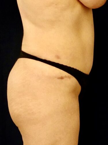 Fat Transfer / Brazilian Butt Lift 05 Before 2