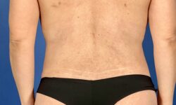 Fat Transfer / Brazilian Butt Lift 05 After