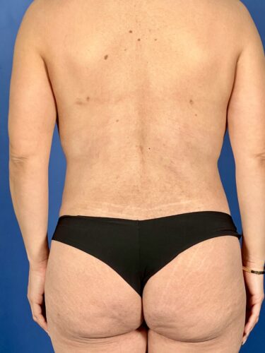 Fat Transfer / Brazilian Butt Lift 05 After 1