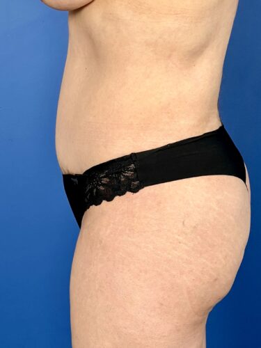 Fat Transfer / Brazilian Butt Lift 05 After 3