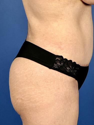 Fat Transfer / Brazilian Butt Lift 05 After 2