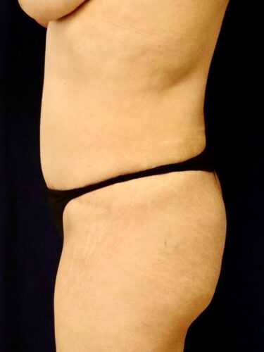 Fat Transfer / Brazilian Butt Lift 05 Before 3