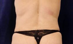 Fat Transfer / Brazilian Butt Lift 05 Before