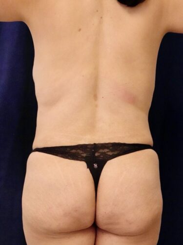 Fat Transfer / Brazilian Butt Lift 05 Before 1