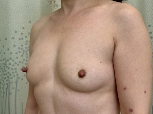 Breast Augmentation 27 Before 2