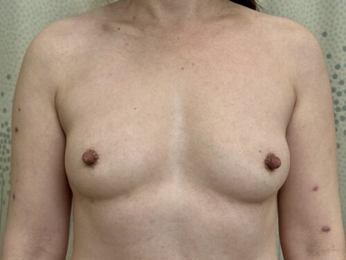 Breast Augmentation 27 Before 1