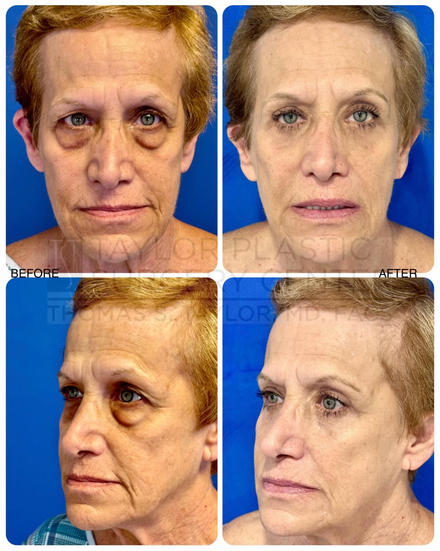 Before and after of a upper and lower blepharoplasty (eyelid surgery) done by Dr. Taylor Photos taken at 1 year post-op #beforeandafter #blepharoplasty #cosmeticsurgery #taylorplasticsurgerycenter #pasadena