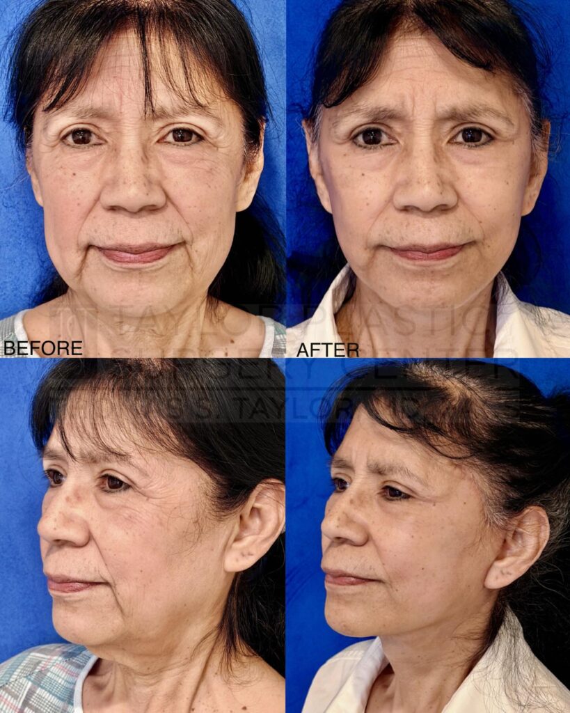 A refreshed look without changing who she is. This full facelift helped restore definition to the jawline, smooth deeper folds, and lift the midface—creating a naturally rejuvenated appearance. Beautiful, balanced, and still completely her. #Facelift #BeforeAndAfter #NaturalResults #FacialRejuvenation #taylorplasticsurgerycenter