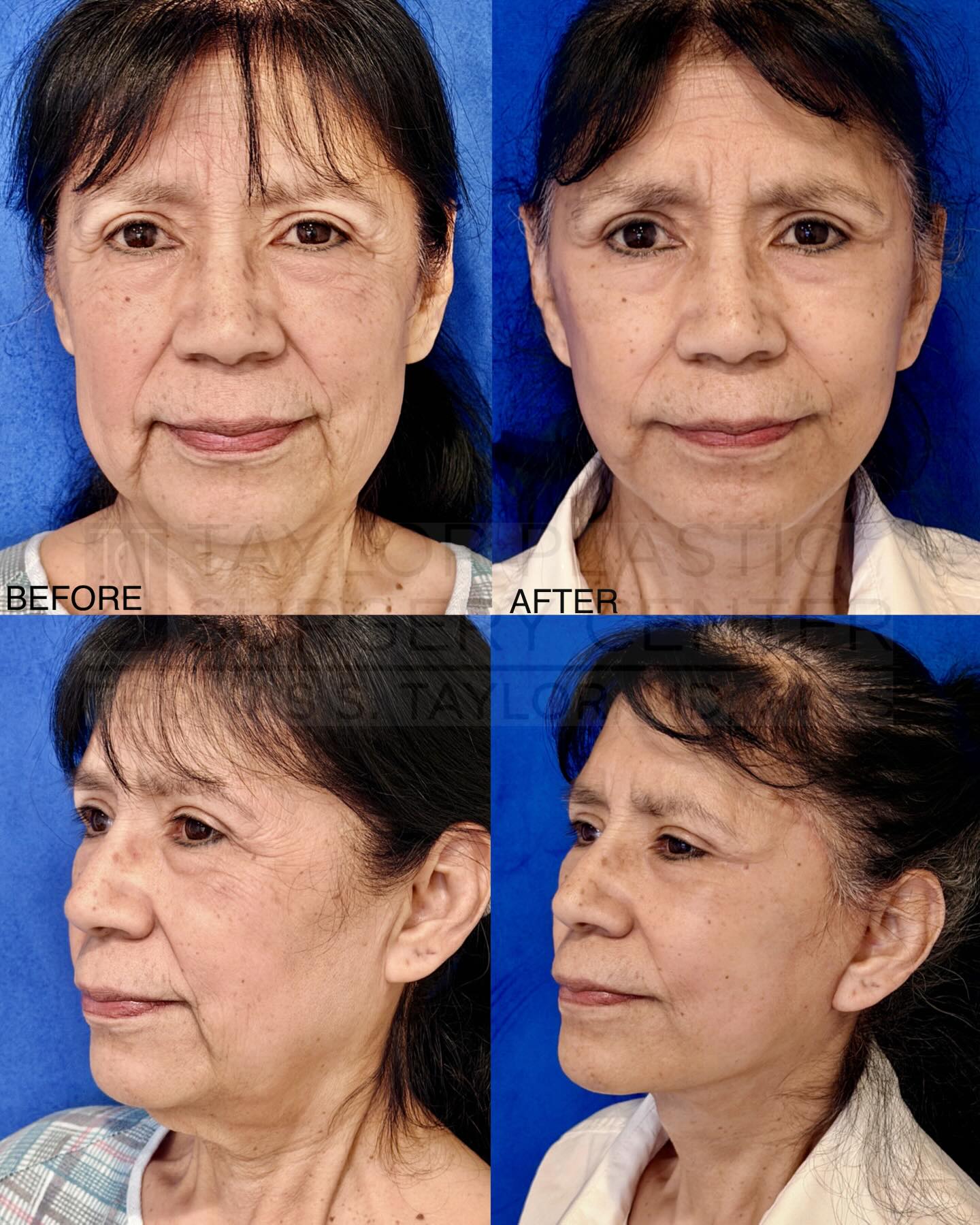 A refreshed look without changing who she is. This full facelift helped restore definition to the jawline, smooth deeper folds, and lift the midface—creating a naturally rejuvenated appearance. Beautiful, balanced, and still completely her. #Facelift #BeforeAndAfter #NaturalResults #FacialRejuvenation #taylorplasticsurgerycenter