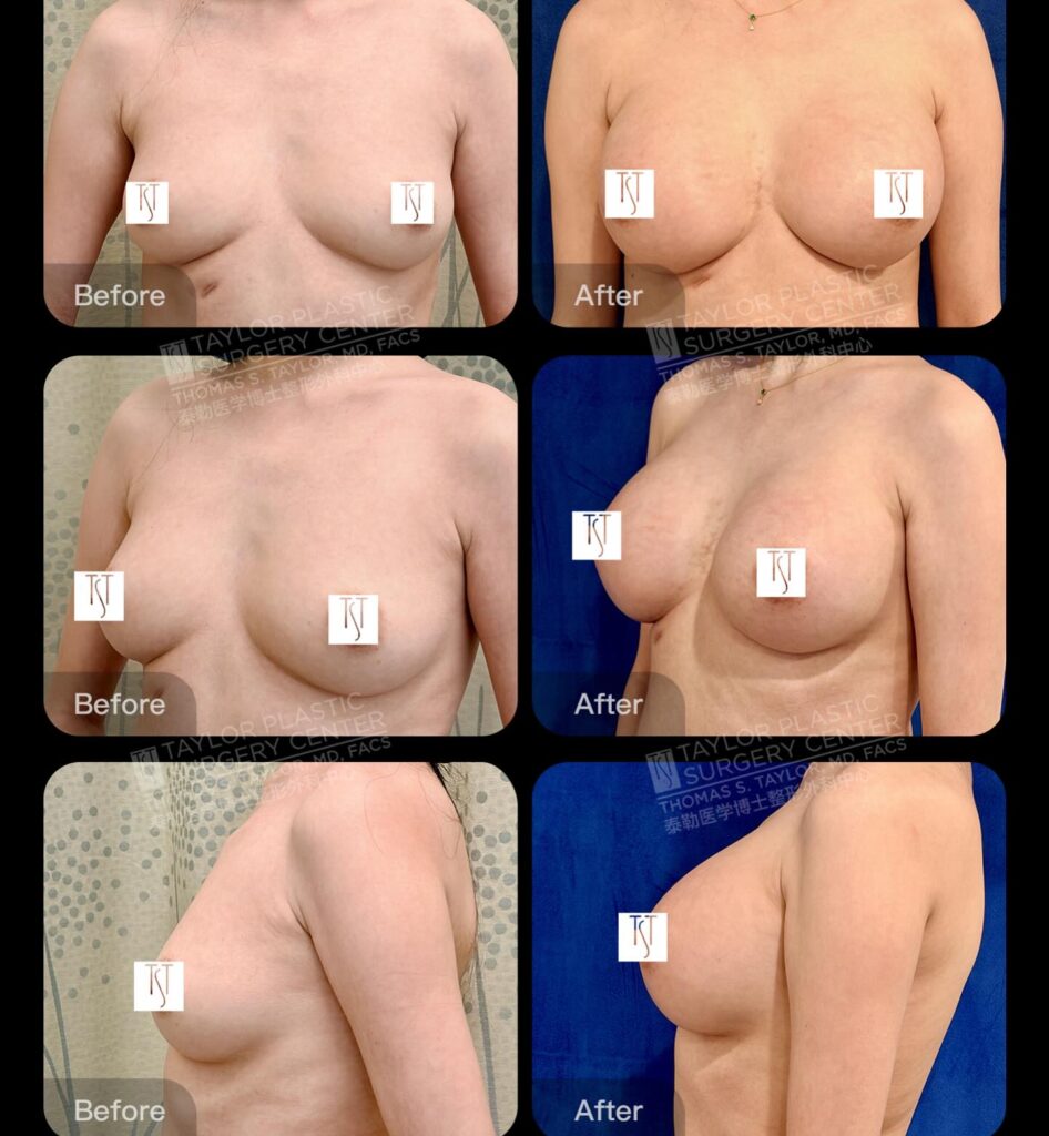 Before and After a Breast Augmentation using @motivaimplants (Patient is 6 weeks post-op) #breastaugmentation #beforeandafter #cosmeticsurgery #taylorplasticsurgerycenter #motivaimplants
