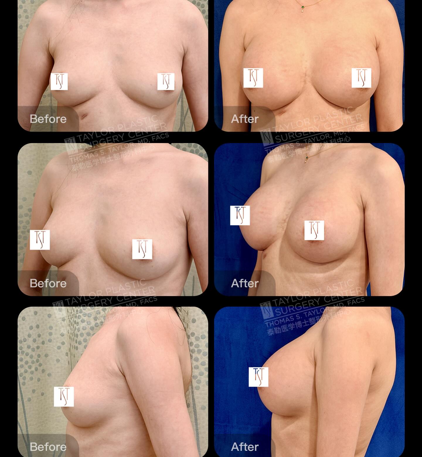 Before and After a Breast Augmentation using @motivaimplants (Patient is 6 weeks post-op) #breastaugmentation #beforeandafter #cosmeticsurgery #taylorplasticsurgerycenter #motivaimplants