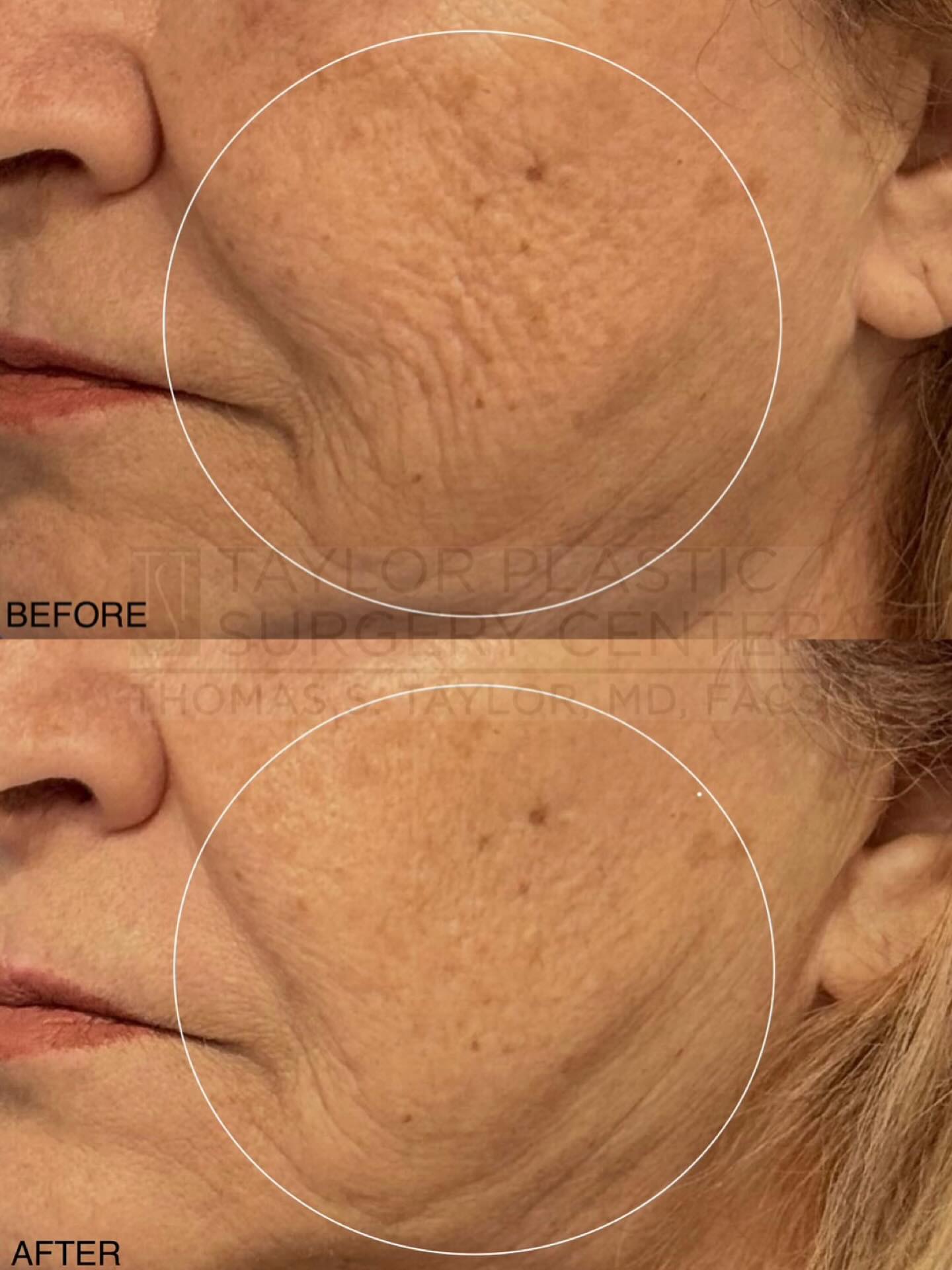 One session. Real results. Skin tightening, smoother texture, and softened lines after just one Morpheus8 treatment—no filters, just collagen doing its thing. Imagine what a full series can do #Morpheus8 #SkinTightening #RealResults #AestheticTreatments #BeforeAndAfter @inmode_losangeles @inmodeaesthetics
