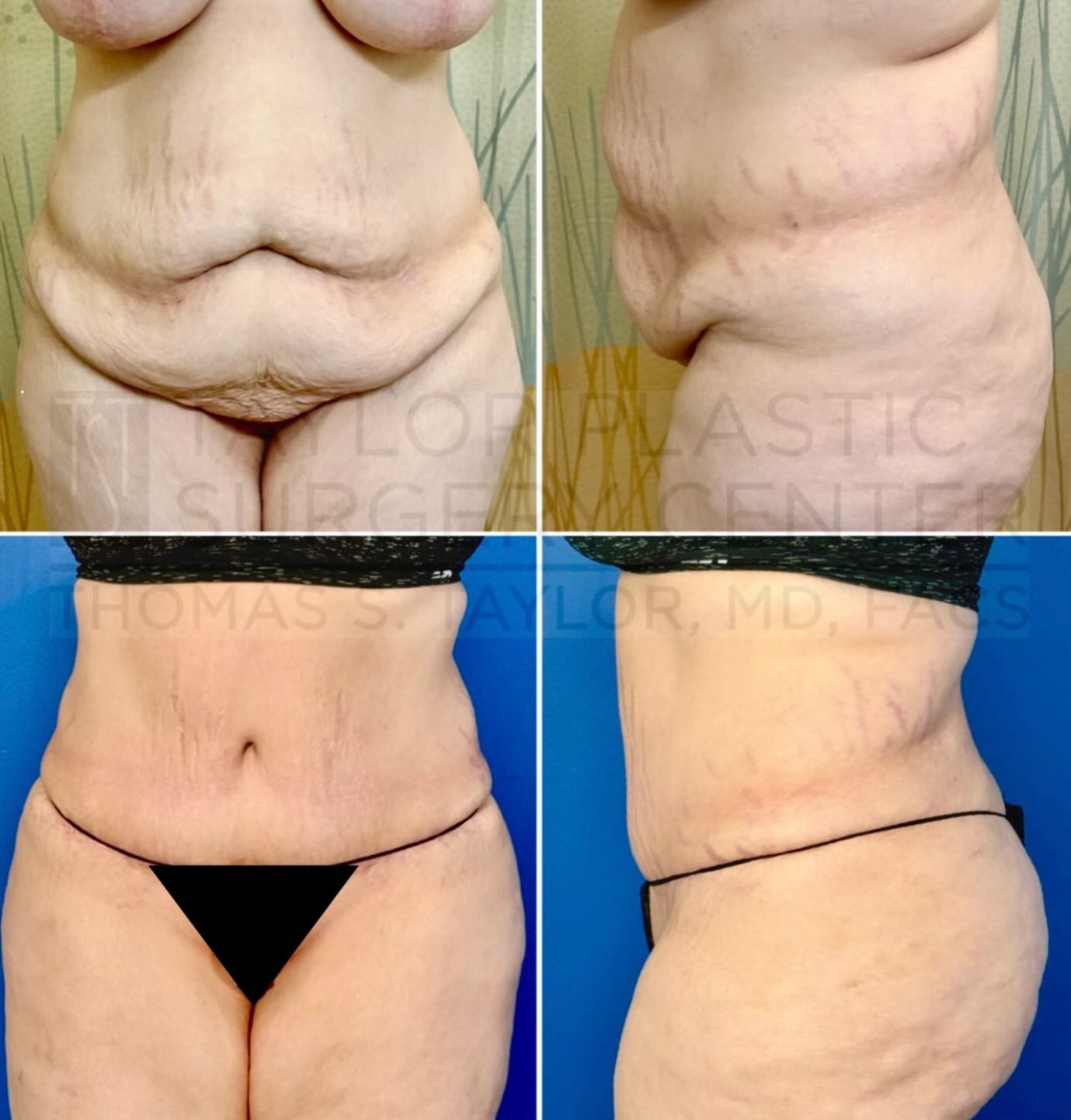 Before and after of an Abdominoplasty done by Dr. Taylor #abdominoplastybeforeandafter #tummytucksurgery #taylorplasticsurgerycenter #pasadenaplasticsurgeon