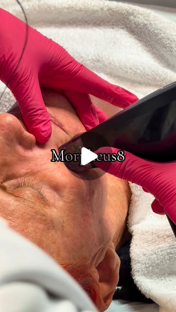 Skin tightening, collagen stimulation, and smoother texture—all in one treatment. Morpheus8 uses radiofrequency microneedling to remodel and contour the skin from within. Results build over time as collagen production increases. Ready for tighter, healthier-looking skin? #Morpheus8 #SkinTightening #RFMicroneedling #CollagenBoost #taylorplasticsurgerycenter @inmode_losangeles @inmodeaesthetics