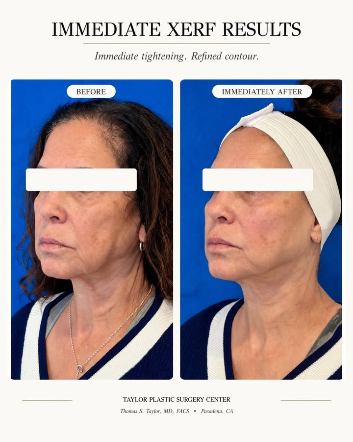 Immediate results after one XERF Face + Neck treatment.